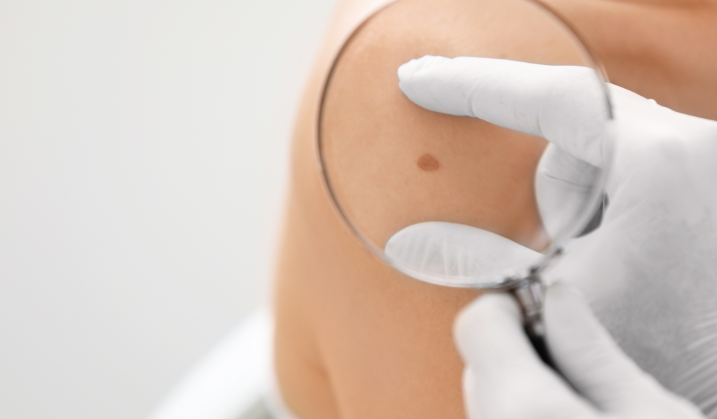melanoma