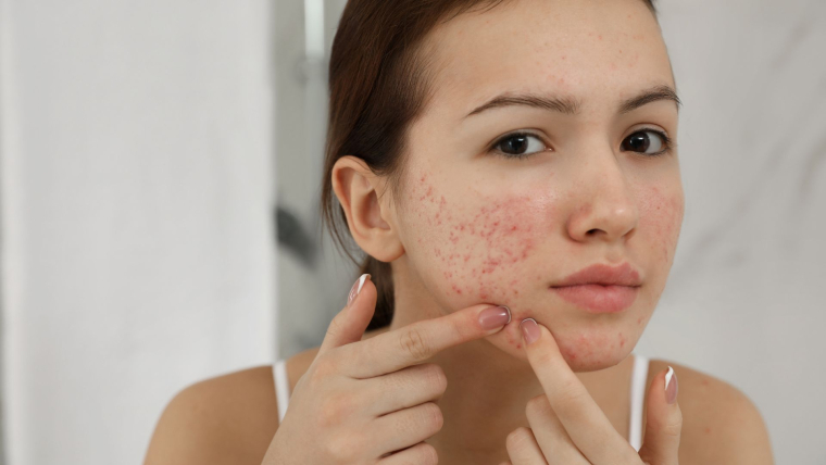 Facial acne map