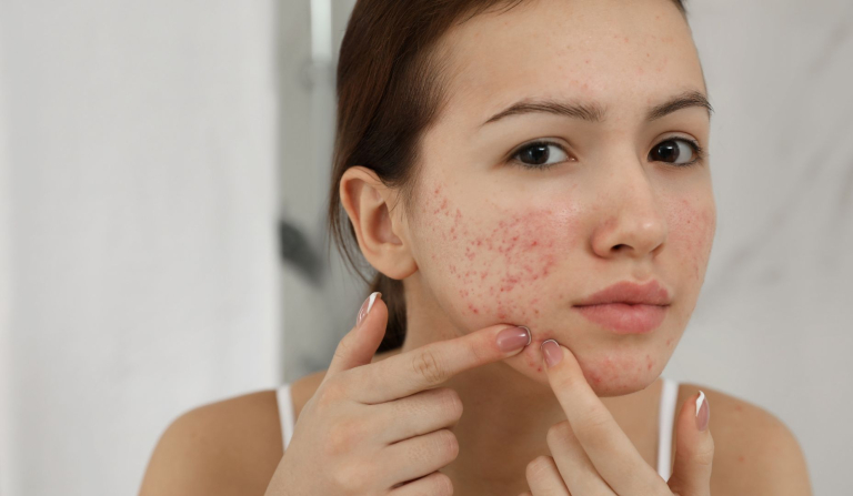 Facial acne map