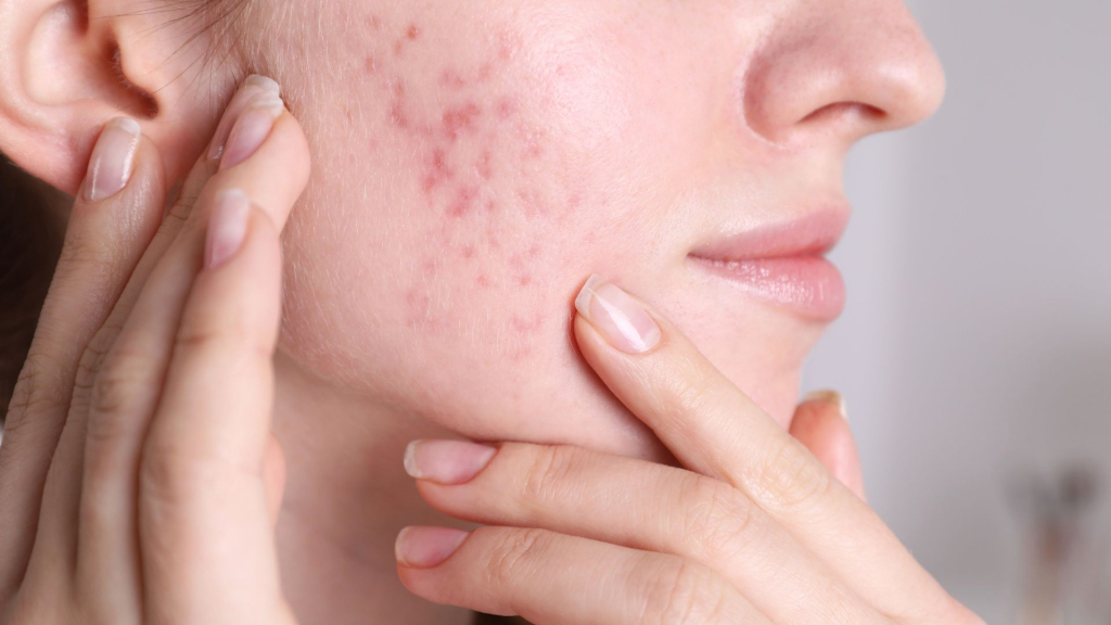 Facial acne map